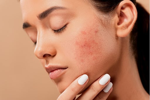 Mono Thread lifts for Acne Scars