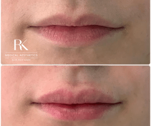 Lip Fillers Affect Your Smile