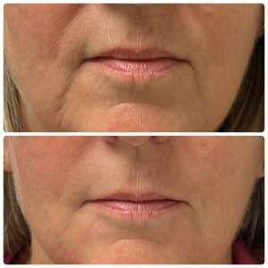 Enhance Your Natural Beauty Features with Dermal Fillers